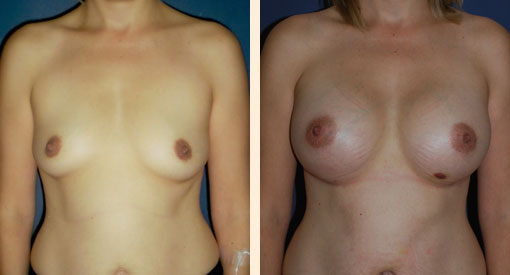 Breast Augmentation Before and After 29