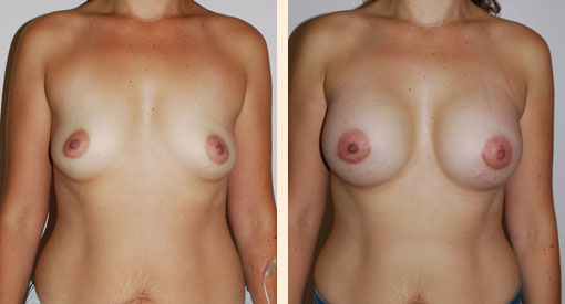 Breast Augmentation Before and After 21