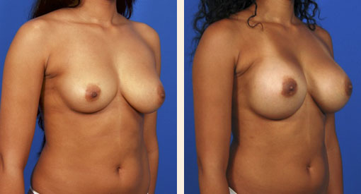 Breast Implant Revision Before and After 03