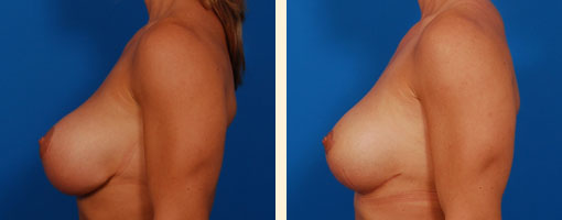 Breast Implant Revision Before and After 06