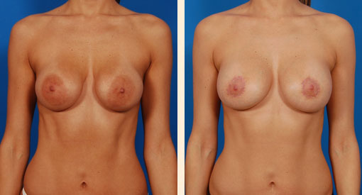 Breast Implant Revision Before and After 11