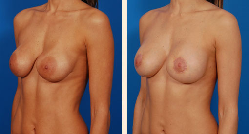 Breast Implant Revision Before and After 07