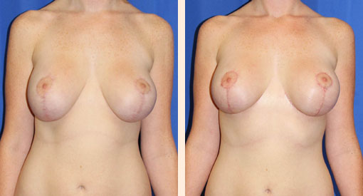 Breast Implant Revision Before and After 07
