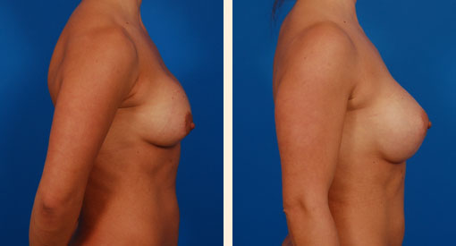 Breast Implant Revision Before and After 10