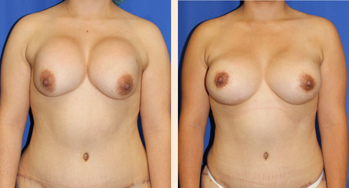 Breast Implant Revision Before and After 13