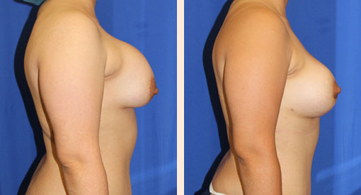 Breast Implant Revision Before and After 11