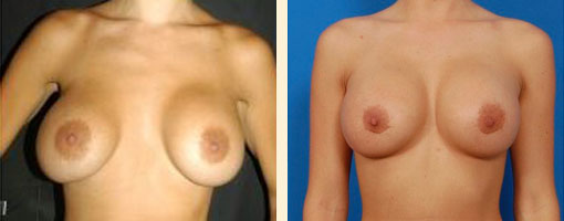 Breast Implant Revision Before and After 15