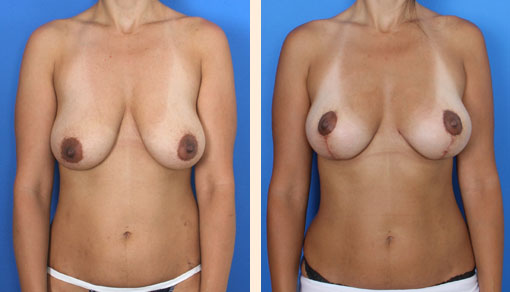 Breast Lift Before and After 13
