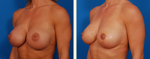 Breast Lift Before and After 03