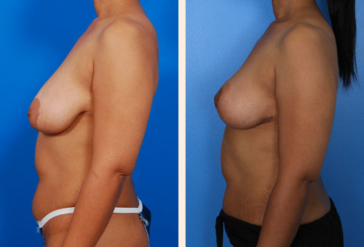 Breast Lift Before and After 05