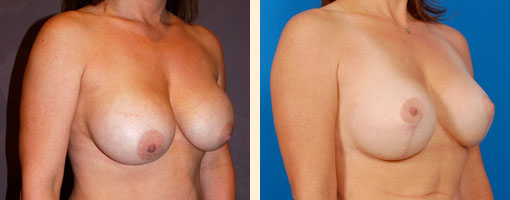 Breast Lift Before and After 10