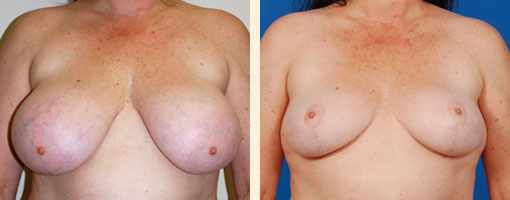 Breast Lift Before and After 09