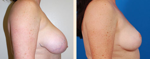Breast Lift Before and After 07