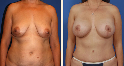 Breast Lift Before and After 12