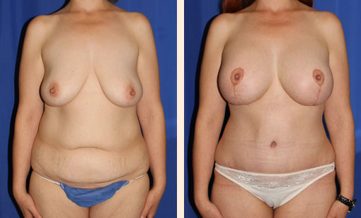Breast Lift Before and After 12