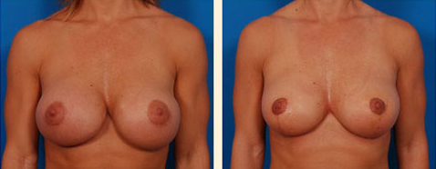 Breast Reduction Before and After 08