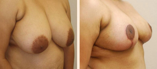 Breast Reduction Before and After 02