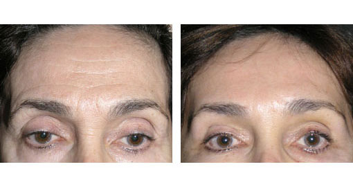 Browlift Before and After 01