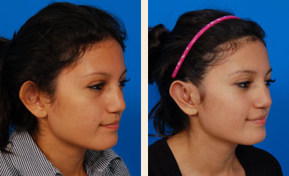 Ear Surgery Before and After 01