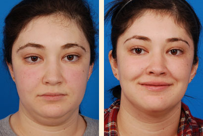 Face And Neck Liposuction Before and After 04