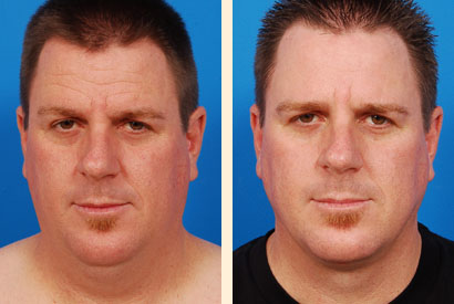 Face And Neck Liposuction Before and After 02