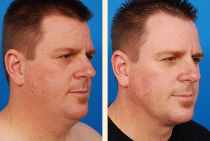 Face And Neck Liposuction Before and After 02