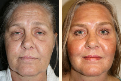 Face And Neck Liposuction Before and After 03