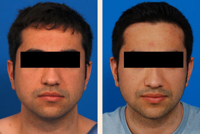Face And Neck Liposuction Before and After 01