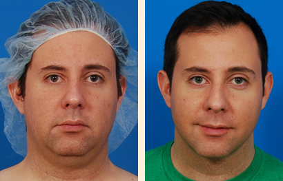 Face And Neck Liposuction Before and After 06