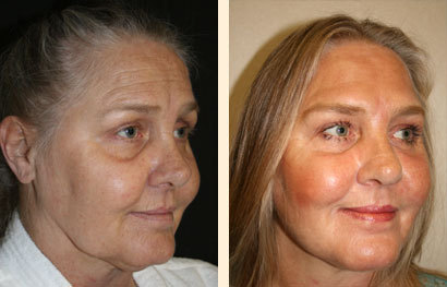Facelift Before and After 05