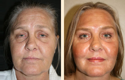 Facelift Before and After 02