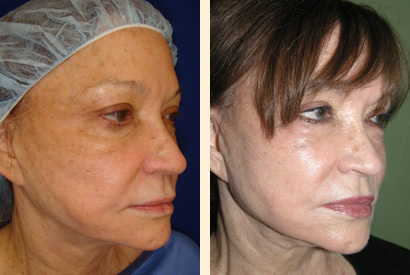 Facelift Before and After 07