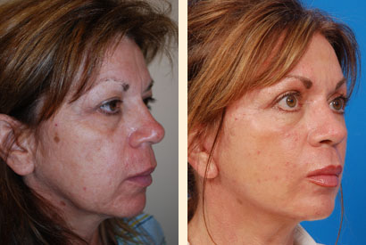 Facelift Before and After 03