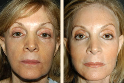 Facial Fat Grafting Before and After 01