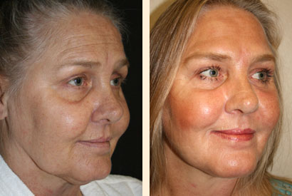 Laser Skin Resurfacing Before and After 01