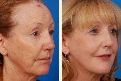 Laser Skin Resurfacing Before and After 01