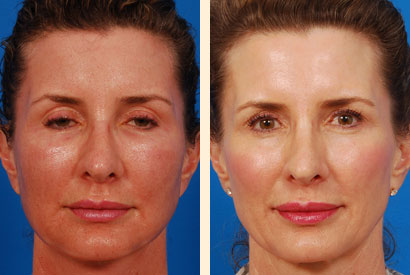 Laser Skin Resurfacing Before and After 02