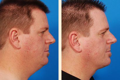 Liposuction For Men Before and After 03