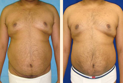 Liposuction For Men Before and After 02