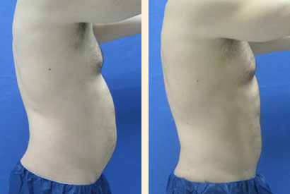 Liposuction For Men Before and After 05