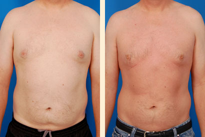 Liposuction For Men Before and After 04