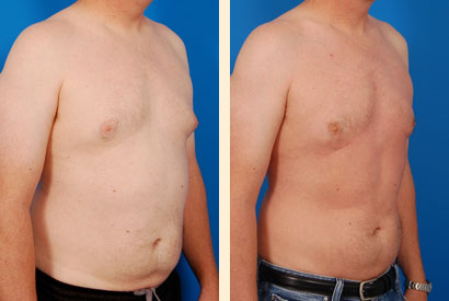 Liposuction For Men Before and After 06