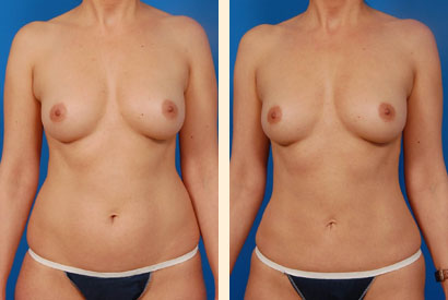 Liposuction Before and After 08
