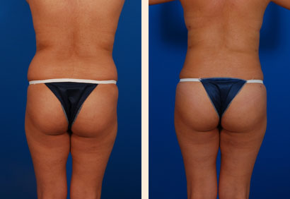 Liposuction Before and After 17