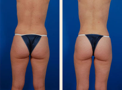 Liposuction Before and After 06