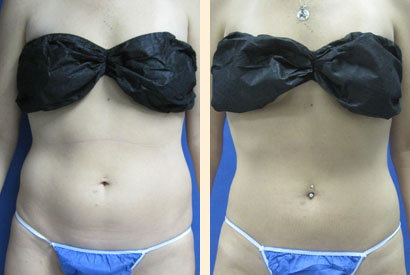 Liposuction Before and After 03