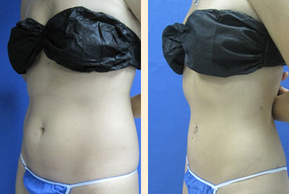 Liposuction Before and After 10