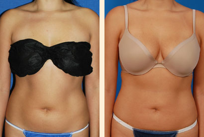Liposuction Before and After 02