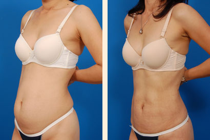 Liposuction Before and After 09