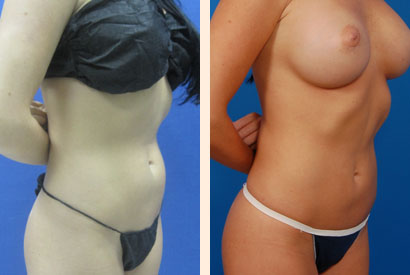 Liposuction Before and After 14